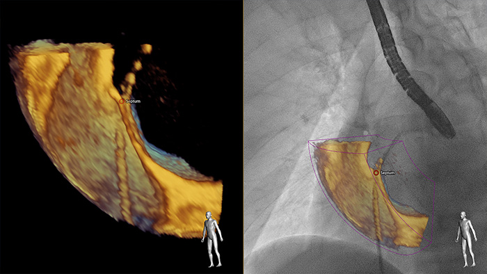 EchoNavigator fusionne automatiquement l'ETO 3D et la radiographie en temps r&eacute;el