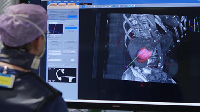 Biopsie et ablation tumorales