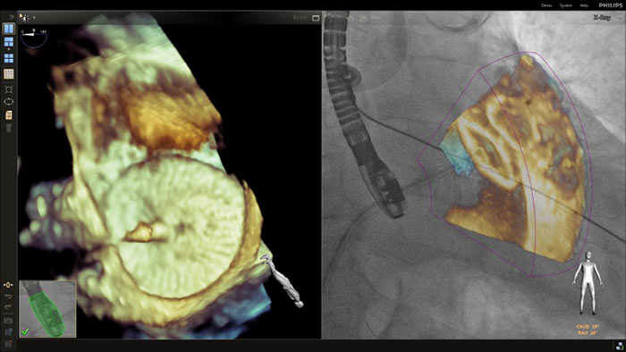 Superposition du zoom 3D dans une proc&eacute;dure de fermeture de l&rsquo;appendice auriculaire gauche