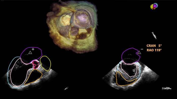 Superposition compl&egrave;te du mod&egrave;le 3D AI EchoNavigator