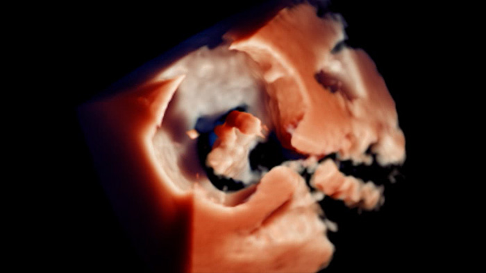 Visualisation TrueVue de la r&eacute;paration mitrale bord &agrave; bord