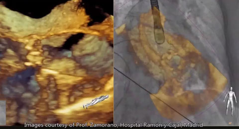  Live 3D TEE wordt in realtime weergegeven op het EchoNavigator-scherm